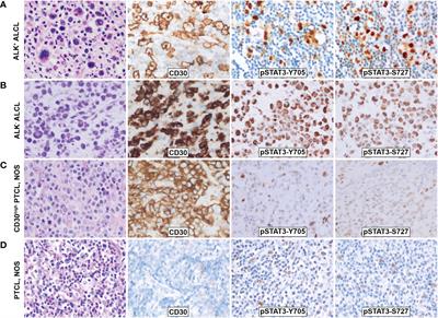 Phosphorylated STAT3 as a potential diagnostic and predictive biomarker in ALK- ALCL vs. CD30high PTCL, NOS